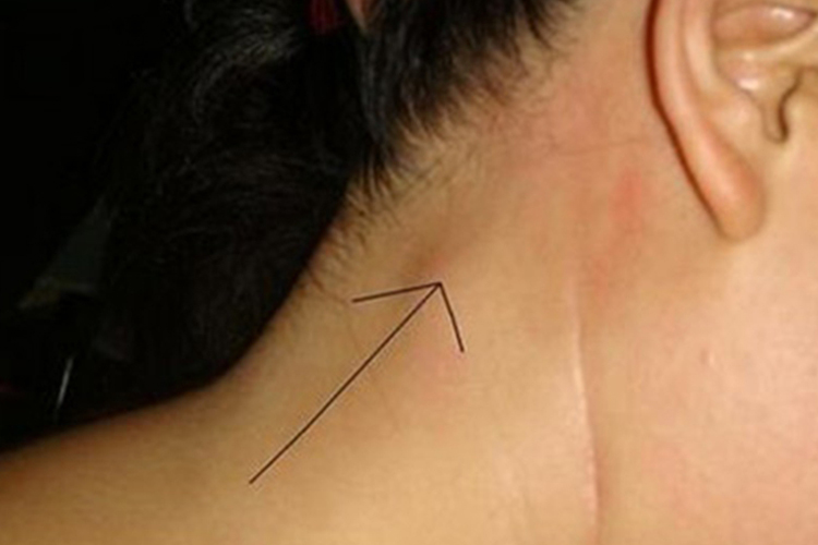 早期艾滋病枕淋巴结肿大图