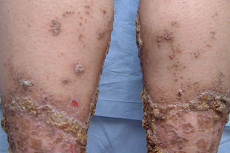 慢性苔藓样角化病小腿结痂图