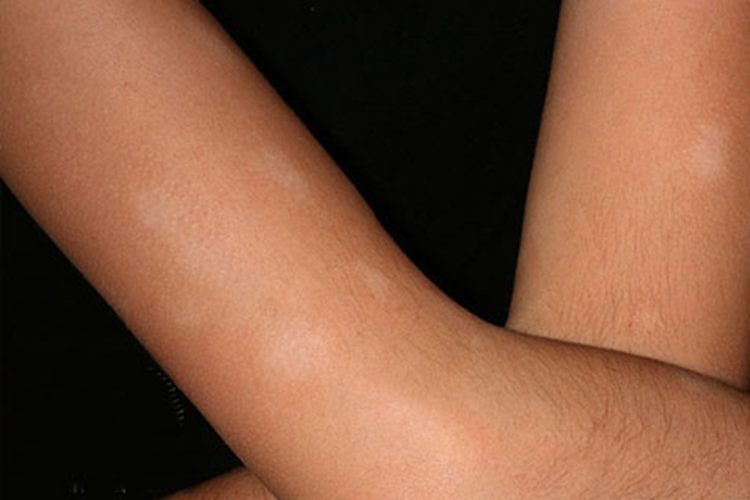 白色糠疹手臂上有白色的小圆点图 白色糠疹手臂上有白色的小圆点图