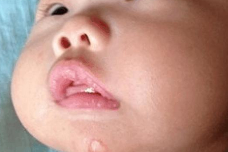 长期吸下嘴唇嘴唇和牙齿变形图