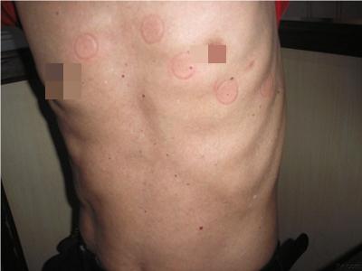樱桃状血管瘤前胸小红点图.jpeg