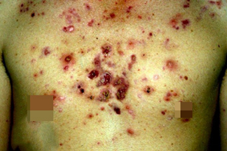 痤疮胸部症状图 痤疮胸部症状图