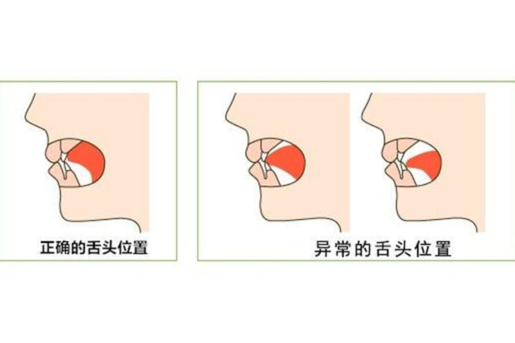 正畸正确的舌头放的位置图