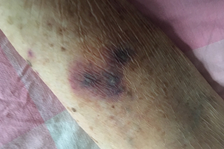 出血性紫癜手臂上有青紫块图 出血性紫癜手臂上有青紫块图