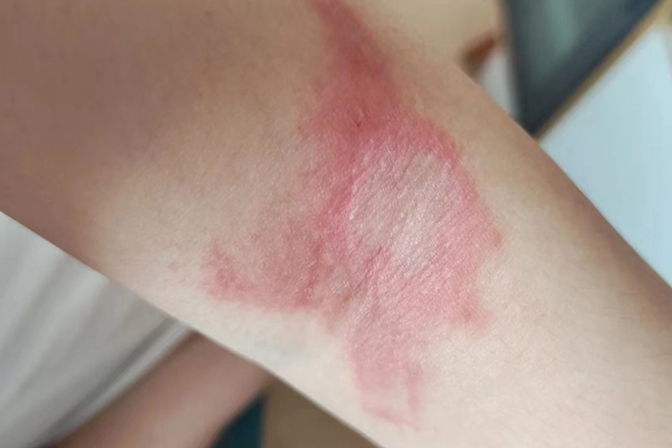 隐翅虫皮炎早期片状红斑图