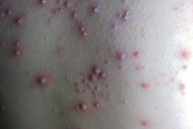 细菌性毛囊炎脓包图