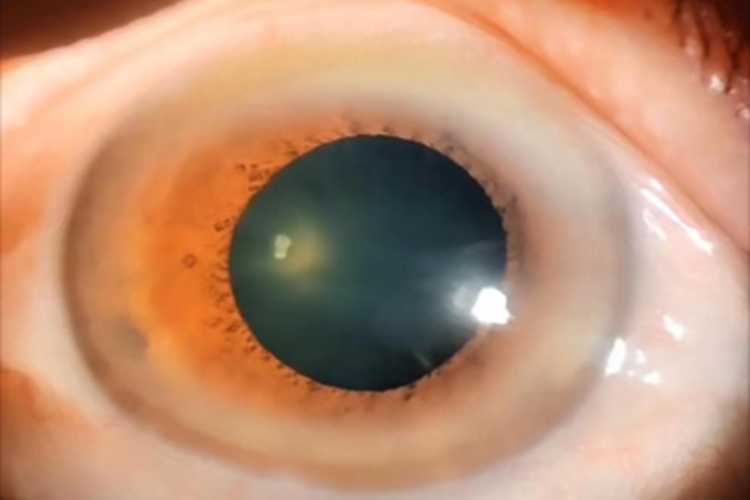 后囊下白内障眼珠混浊图 后囊下白内障眼珠混浊图