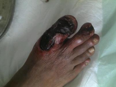 血栓闭塞性脉管炎脚趾发黑坏死图.jpg