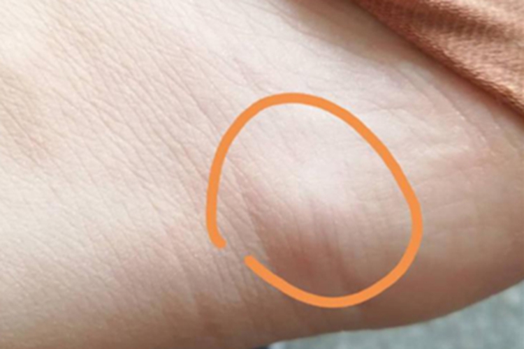 平滑肌瘤脚后跟症状图