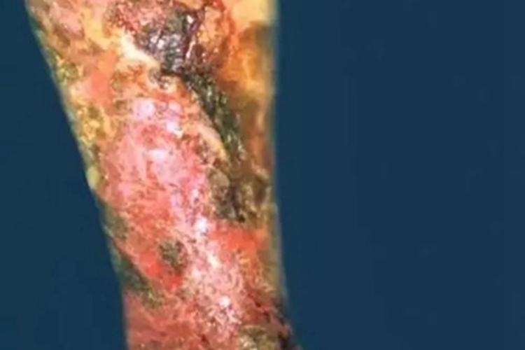 硬红斑小腿症状图 硬红斑小腿症状图