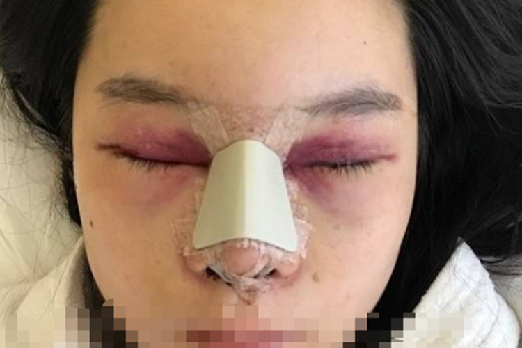 隆鼻眼睛周围瘀血图 隆鼻眼睛周围瘀血图