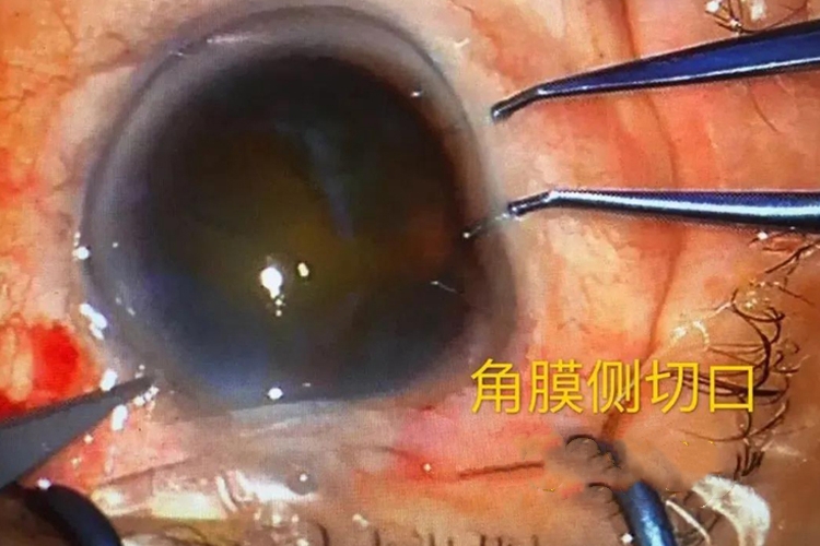 白内障手术切口位置图