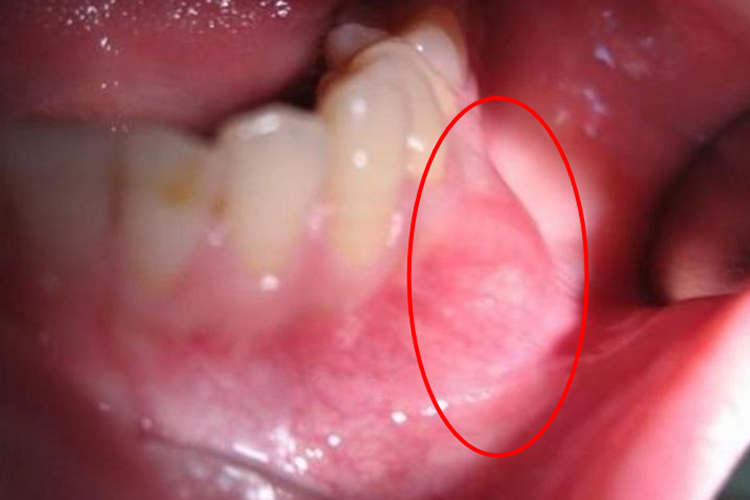 下颌骨骨化纤维瘤