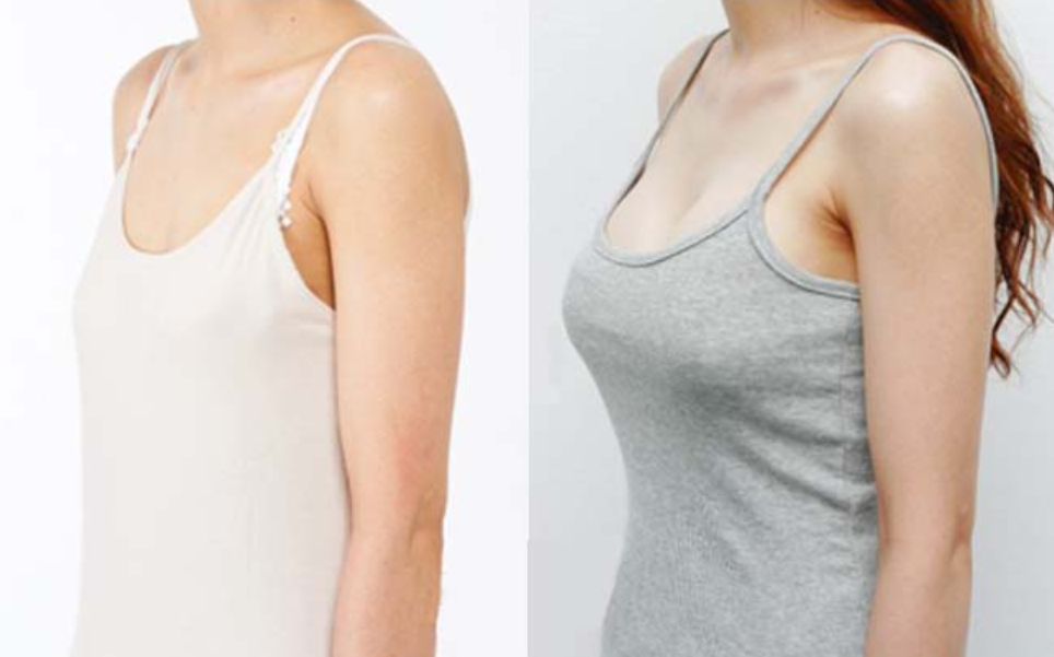 隆胸效果对比图