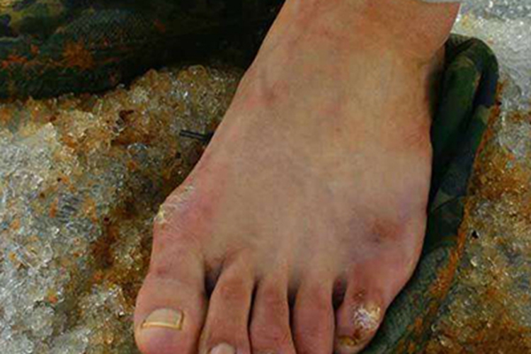 Ⅱ度冻伤脚部症状图 Ⅱ度冻伤脚部症状图