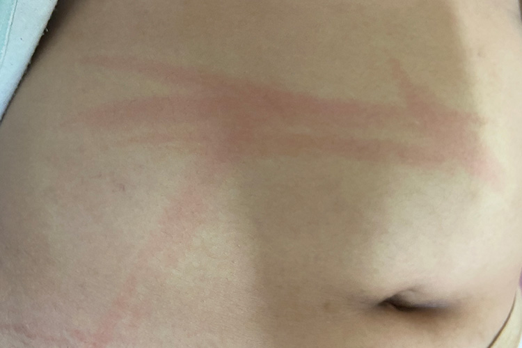 人工荨麻疹风团图