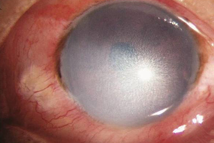 重度眼角膜碱性烧伤图