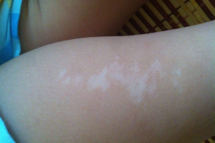 幼儿汗斑早期图