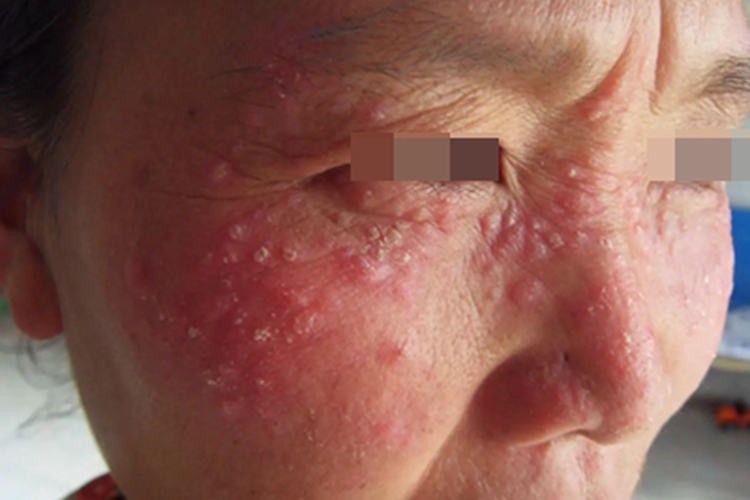 疱疹样脓疱病面部红斑图