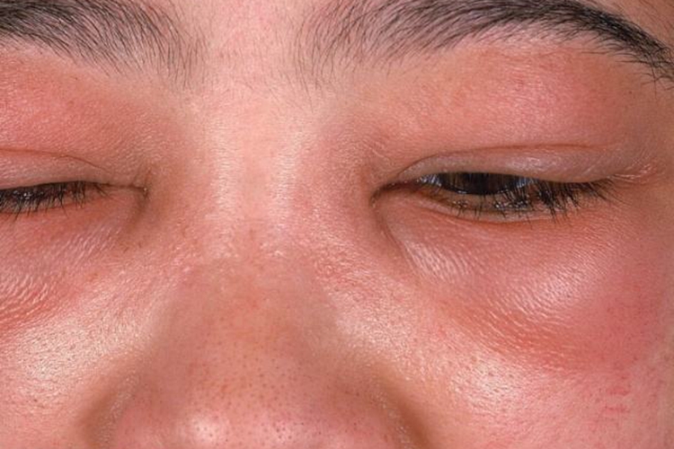 豆腐过敏眼睑水肿图