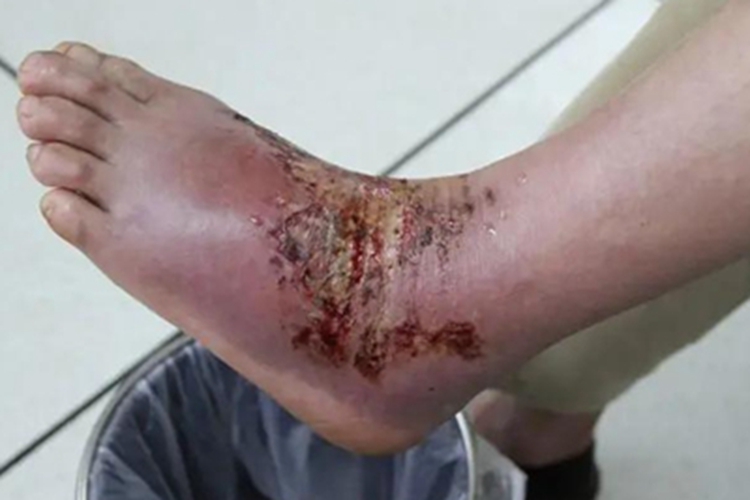 三度烫伤结痂图 三度烫伤结痂图