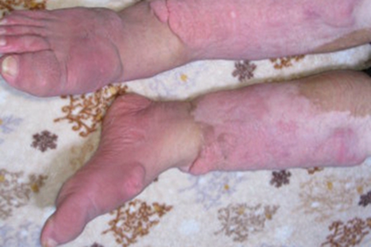 甲状腺功能减退症小腿水肿图 甲状腺功能减退症小腿水肿图