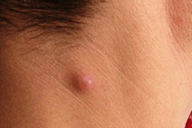 结节皮损图 结节皮损图