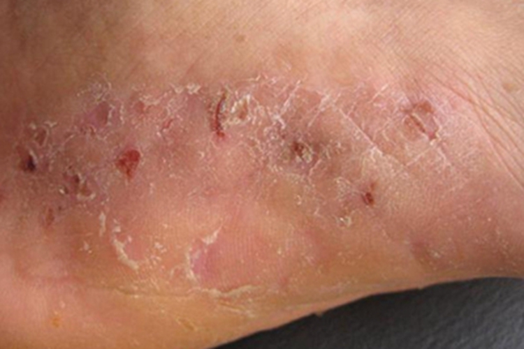 艾滋病感染性皮肤损害脚底症状图