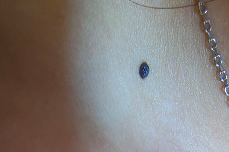 皮内痣胸部有凸起黑痣图 皮内痣胸部有凸起黑痣图