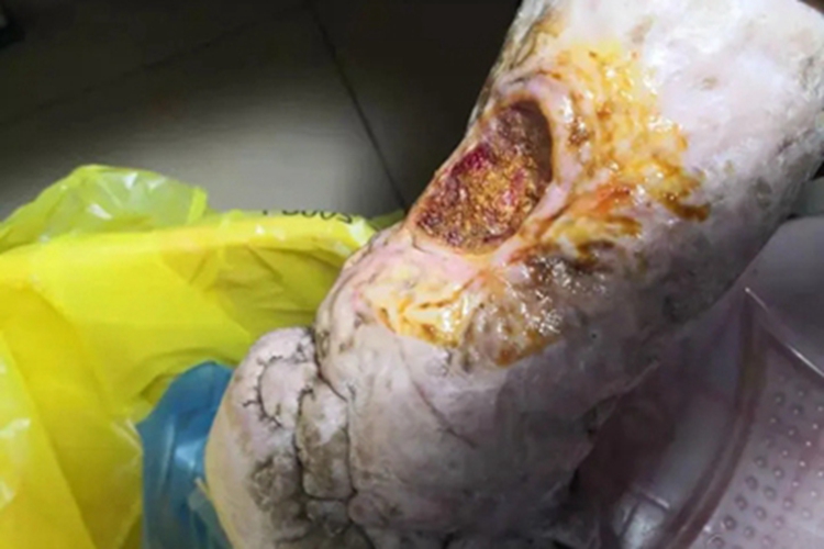 皮肤丝虫病腿溃疡图