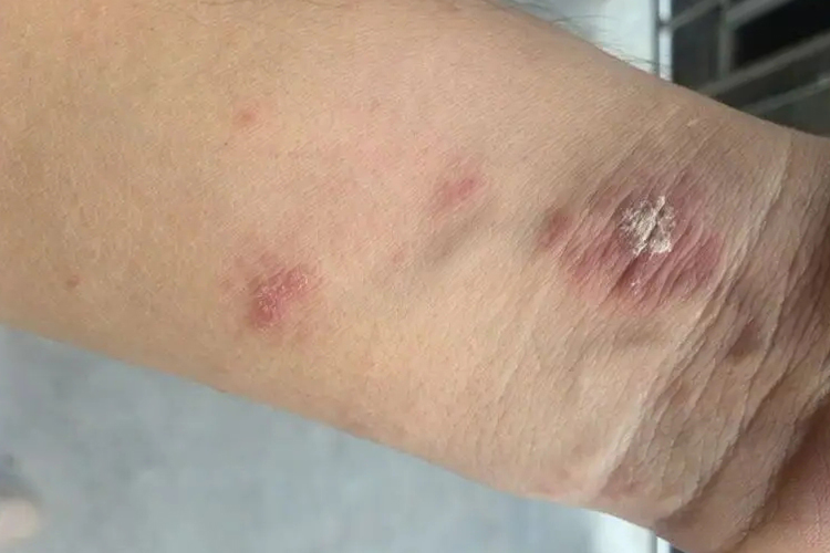 艾滋病初期手臂玫瑰糠疹图 艾滋病初期手臂玫瑰糠疹图