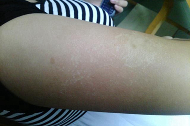 硬肿病胳膊僵硬图