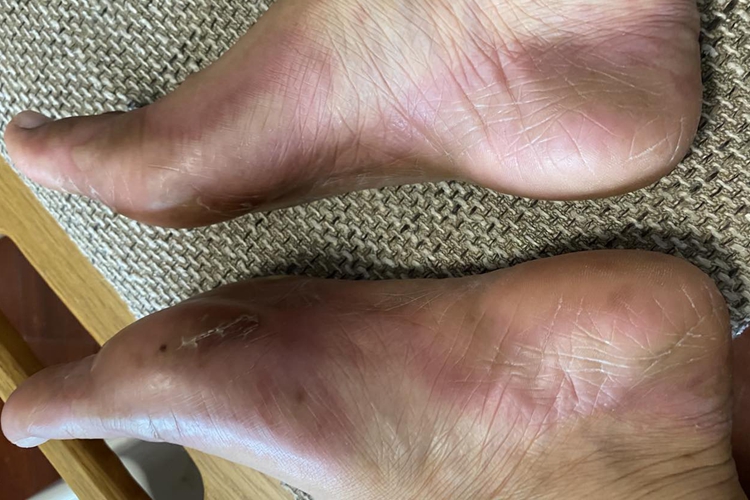 3级手足综合征脚部症状图