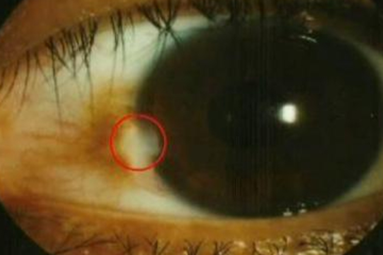 睑裂斑白色结节凸起图 睑裂斑白色结节凸起图