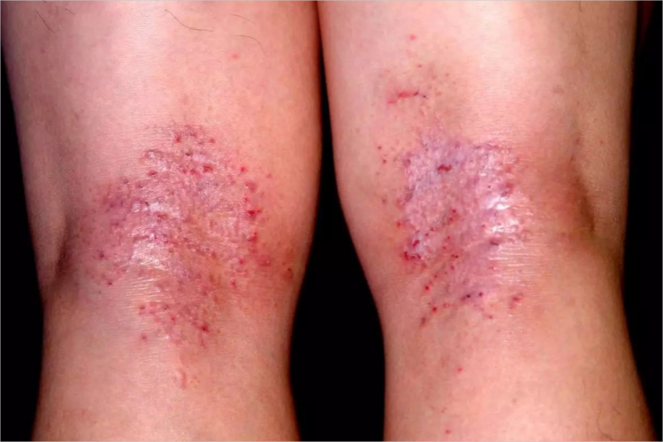 亚急性湿疹腘窝症状图