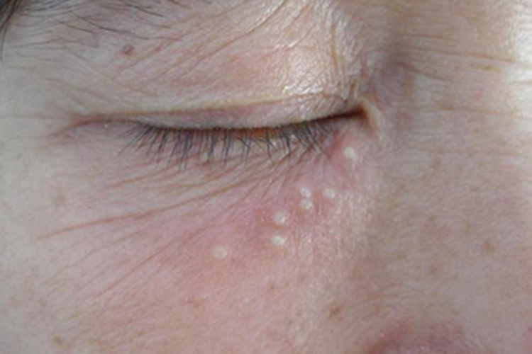 眼角单纯疱疹一串水疱图