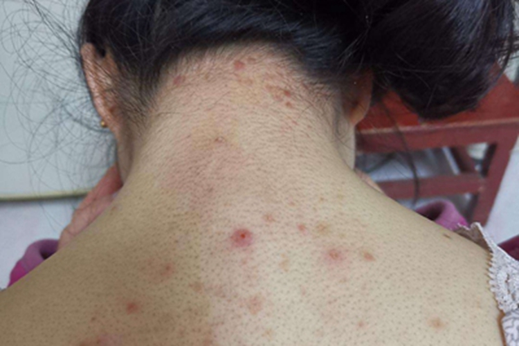 马拉色菌毛囊炎背部血点图 马拉色菌毛囊炎背部血点图