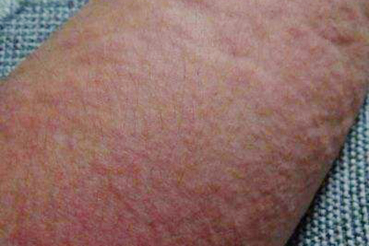 慢性自发性荨麻疹图 慢性自发性荨麻疹图