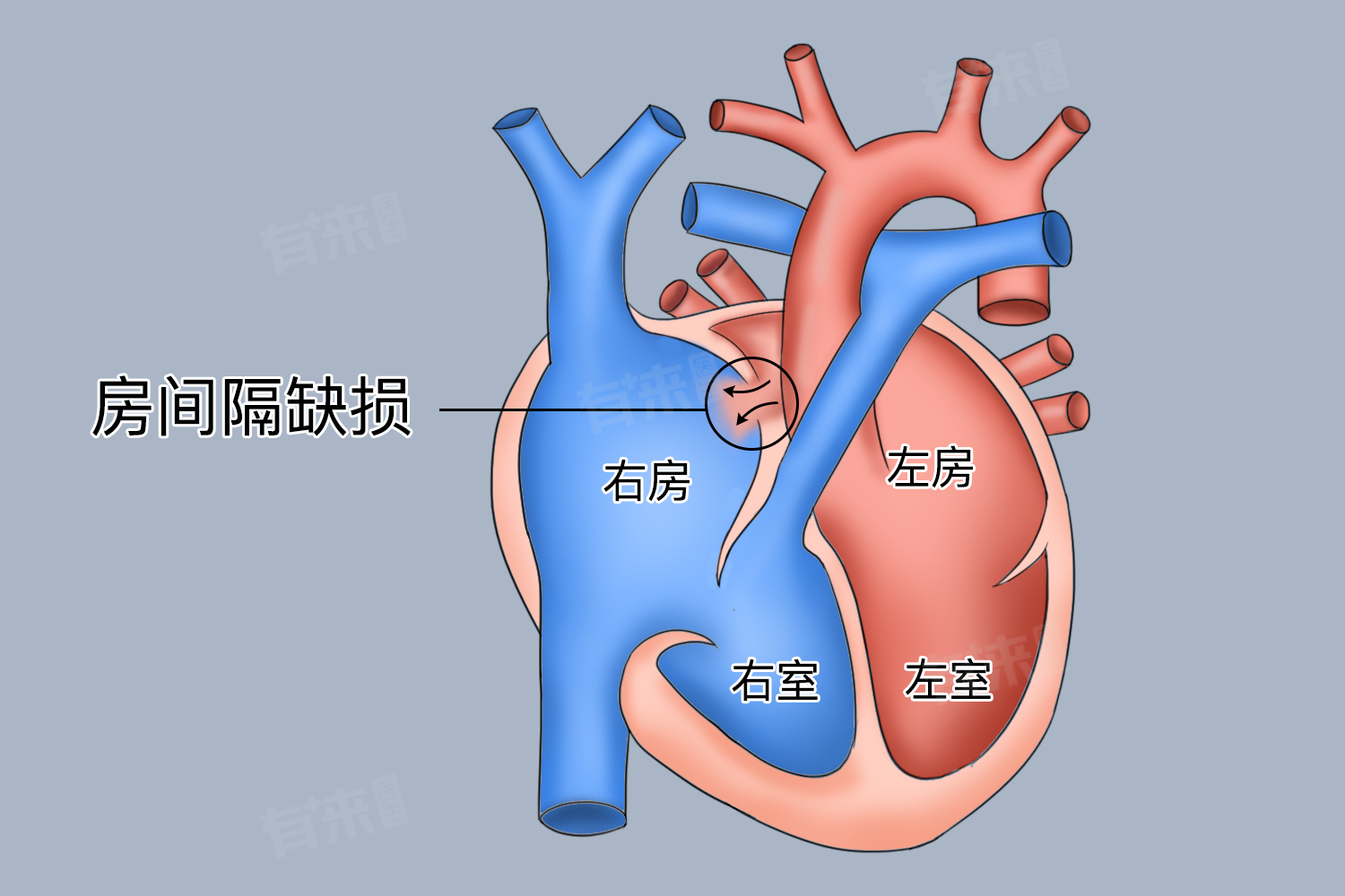 房间隔缺损介入封堵术多少钱