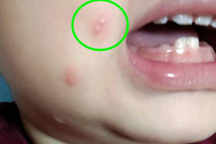 蚊子叮咬及引起的皮肤反应水疱图 蚊子叮咬及引起的皮肤反应水疱图