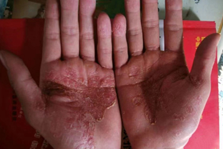 脓疱型银屑病手部脱屑图