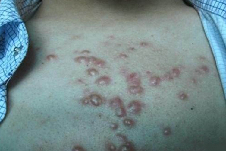 聚合性痤疮胸部脓肿图 聚合性痤疮胸部脓肿图