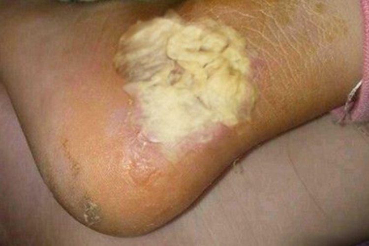皮肤白喉脚踝糜烂泛白图