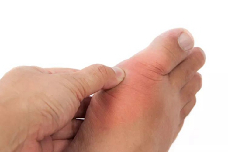 痛风脚趾红肿图