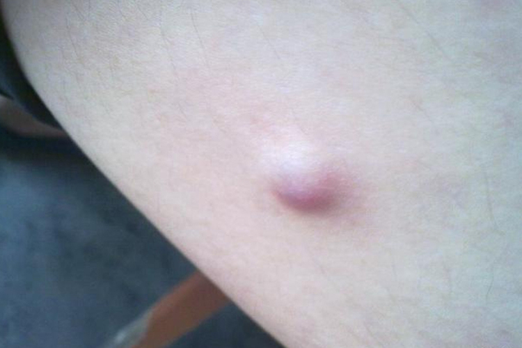 大腿根部内侧皮肤纤维瘤图