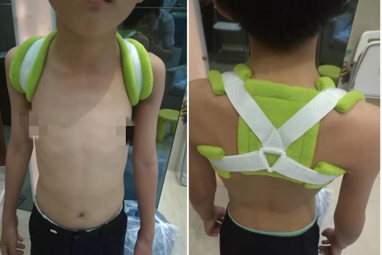 三角巾锁骨骨折固定方法图 三角巾锁骨骨折固定方法图