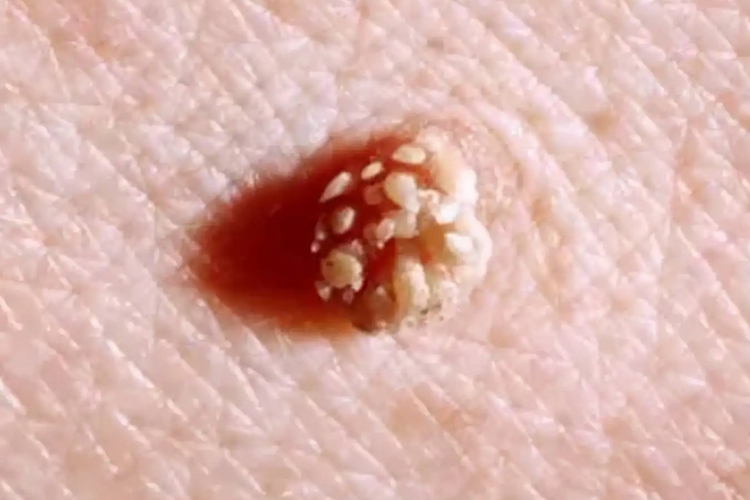 身上长尖锐湿疣图