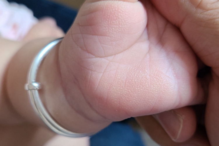 弥漫性掌跖角化病手掌症状图 弥漫性掌跖角化病手掌症状图