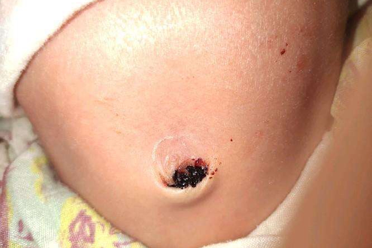 新生儿脐带血痂图