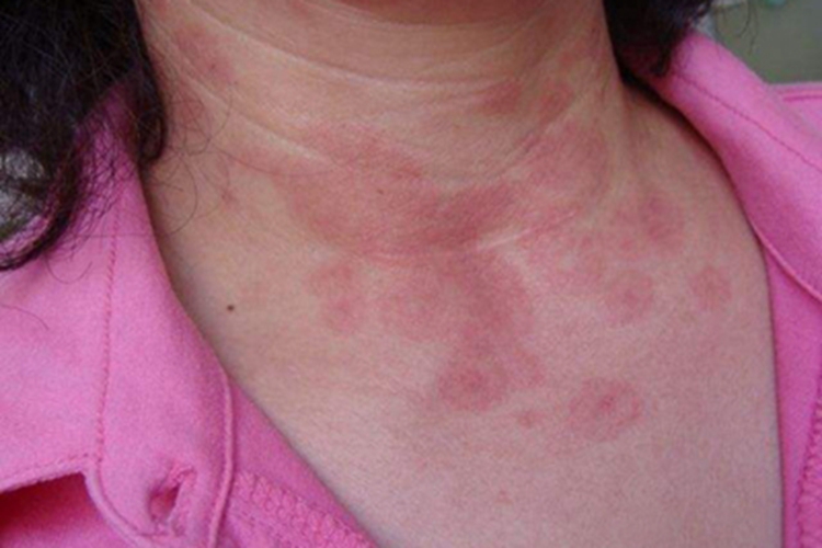 多形红斑型多形性日光疹症状图